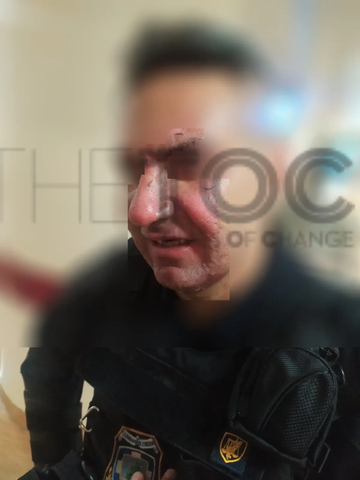 Επεισόδια στο Σύνταγμα: Φωτογραφίες - σοκ από τους τραυματίες αστυνομικούς - Δέχθηκαν επίθεση με μολότοφ σε ευθεία βολή
